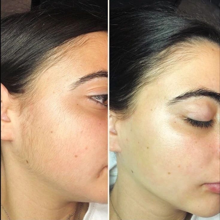 Removedor Facial 2*1  Eléctrico Sin Dolor – Piel Suave en Segundos